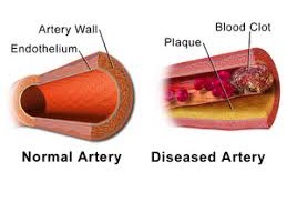 Understanding and Managing Thrombosis and Embolism of Blood Vessels Understanding and Managing Thrombosis and Embolism of Blood Vessels
